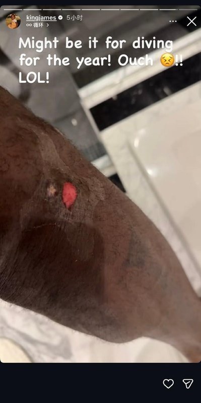 詹姆斯腿部伤口曝光,那次飞身救球堪称经典;疼痛难忍却换来胜利喜悦。 体育新闻
